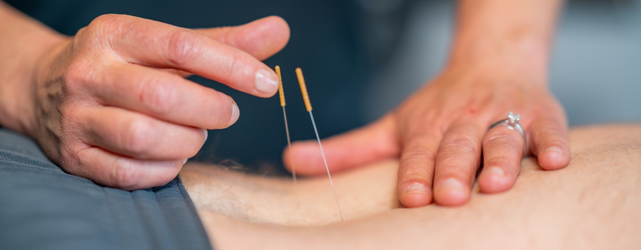 dry-needling-Flowstate-Physical-Therapy-Tuscaloosa-AL