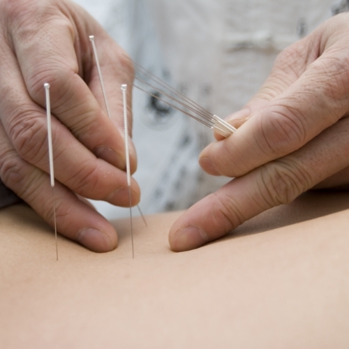 dry-needling-Flowstate-Physical-Therapy-Tuscaloosa-AL